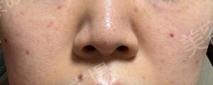 治療直後の症例写真