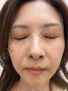 治療直後の症例写真