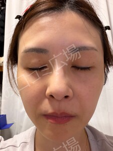 治療直後の症例写真