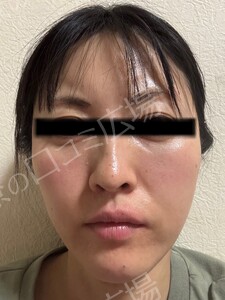 治療前の症例写真