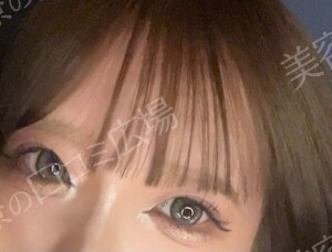 治療直後の症例写真