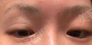 治療直後の症例写真