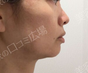 ボルニューマ｜フェイスラインのたるみの治療結果の症例写真
