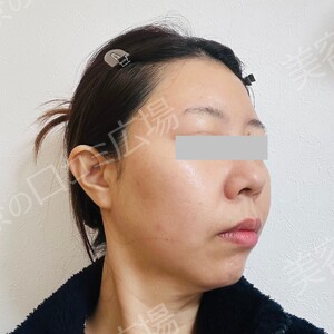 白玉ハイパー点滴（高濃度グルタチオン1200㎎）の治療直後の症例写真