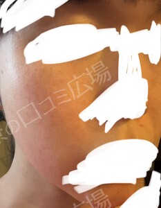 治療前の症例写真