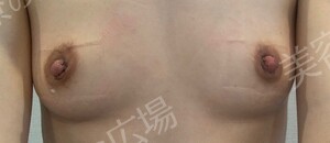 治療直後の症例写真