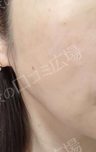 治療結果の症例写真