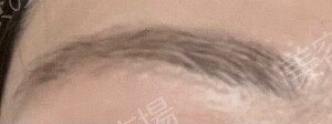 静岡美容外科橋本クリニックの目・二重整形の症例写真[ビフォー]