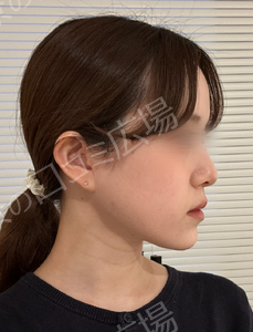 貴族手術（鼻翼基部プロテーゼ）｜ほうれい線を改善の治療前の症例写真