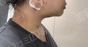 治療直後の症例写真