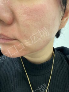 治療直後の症例写真