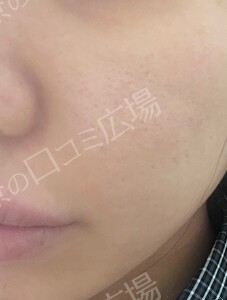 ララドクター｜低刺激ピーリング｜ララピール進化版の治療前の症例写真