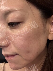 【初回｜平日限定】高出力！ルメッカ2周｜透明感あるお肌に🌿の治療結果の症例写真