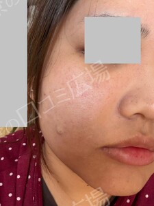 治療直後の症例写真