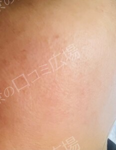 治療直後の症例写真