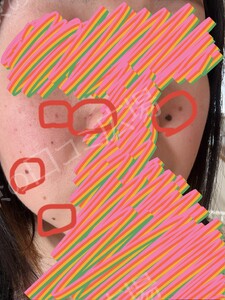 治療前の症例写真