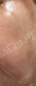治療直後の症例写真