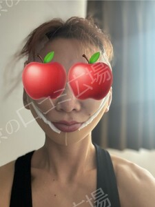 治療直後の症例写真