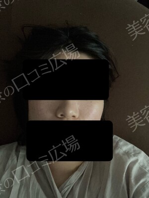 さっぽろ美容クリニック 本院の医療脱毛の症例写真[ビフォー]