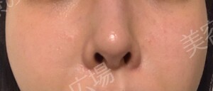 ジェネシスの治療直後の症例写真