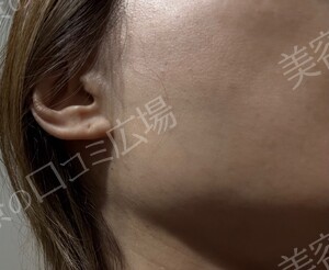 治療直後の症例写真