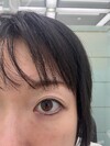 施術後の状態
