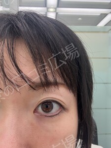 リップ ＆ アイライン上下 アートメイク 2回 モニター施術の治療結果の症例写真