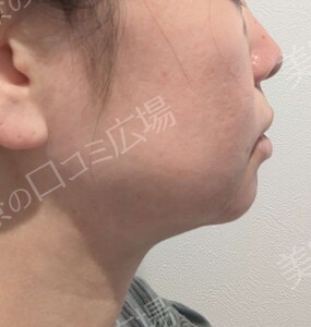 医療ハイフ｜頬・フェイスラインのたるみの治療前の症例写真