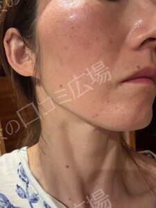 治療前の症例写真