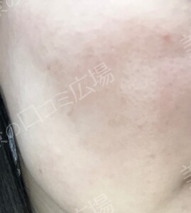 治療直後の症例写真
