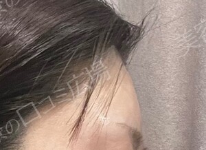 治療直後の症例写真