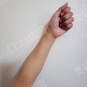白玉ハイパー点滴（高濃度グルタチオン1200㎎）の治療直後の症例写真
