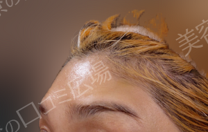 治療直後の症例写真