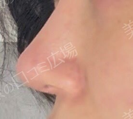 ハイドラジェントル｜毛穴の黒ずみを集中的に除去の治療直後の症例写真