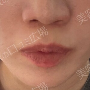 ジョウクリニックのシミ取り・肝斑・毛穴治療の症例写真[ビフォー]