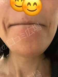 治療直後の症例写真
