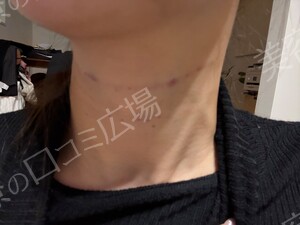 治療直後の症例写真