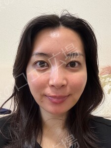 治療直後の症例写真