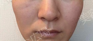 治療直後の症例写真