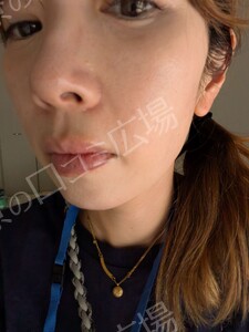 治療結果の症例写真