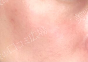 治療直後の症例写真