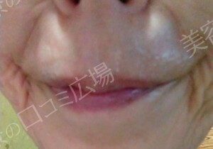 治療直後の症例写真
