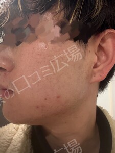 治療直後の症例写真