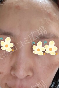 治療直後の症例写真