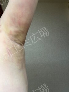 治療直後の症例写真