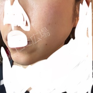 治療前の症例写真