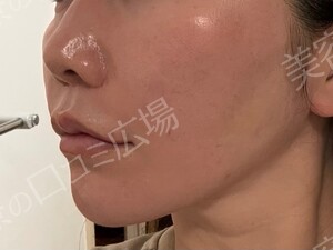 治療直後の症例写真