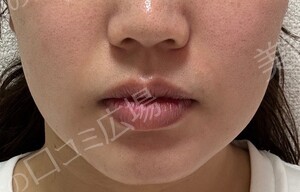 治療直後の症例写真