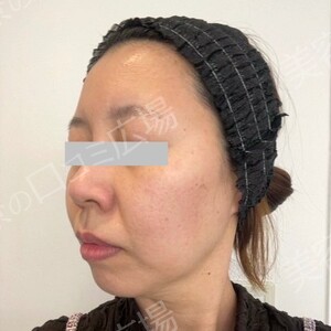 白玉ハイパー点滴（高濃度グルタチオン1200㎎）の治療前の症例写真