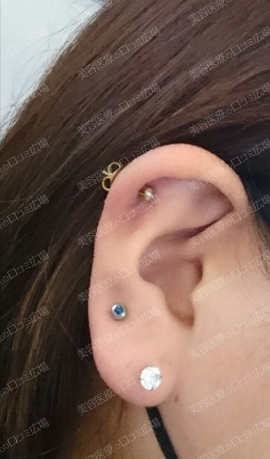 [30代 女性] 耳軟骨（ヘリックス）（ピアス穴あけ）の症例写真 (CS62748)｜新宿美容外科クリニック《美容医療の口コミ広場》